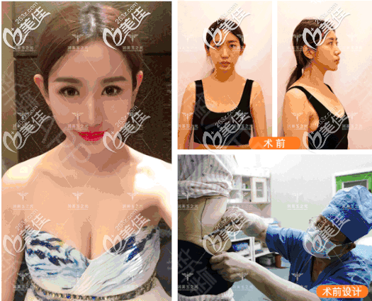 王明利48萬隆胸手術(shù)案例 王明利48萬隆胸手術(shù)案例