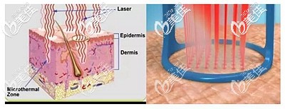 點(diǎn)陣激光祛疤的原理 點(diǎn)陣激光祛疤的原理