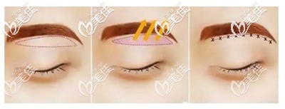 提眉手術(shù)的切口位置 提眉手術(shù)的切口位置