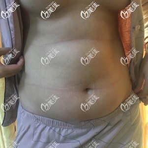 做腰腹吸脂手術(shù)前自己的大肚腩 做腰腹吸脂手術(shù)前自己的大肚腩