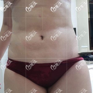 吸脂瘦腰腹術(shù)后25天效果 吸脂瘦腰腹術(shù)后25天效果