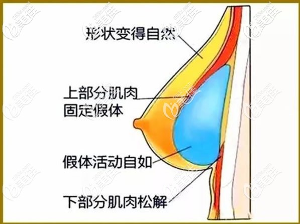 雙平面隆胸優(yōu)勢