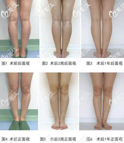 輕度膝內(nèi)翻畸形的手術(shù)方法