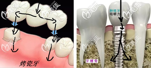 烤瓷牙和種植牙的受力圖