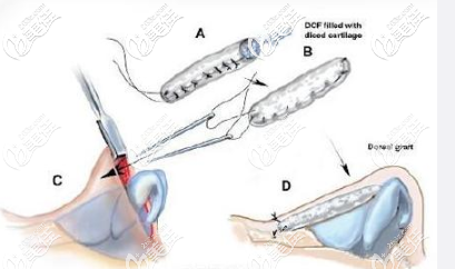 土耳其軟糖隆鼻手術(shù)原理 土耳其軟糖隆鼻手術(shù)原理