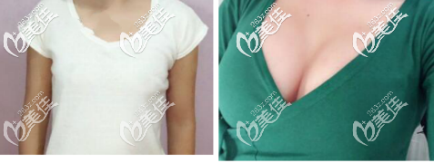 假體隆胸250高凸效果前后對比
