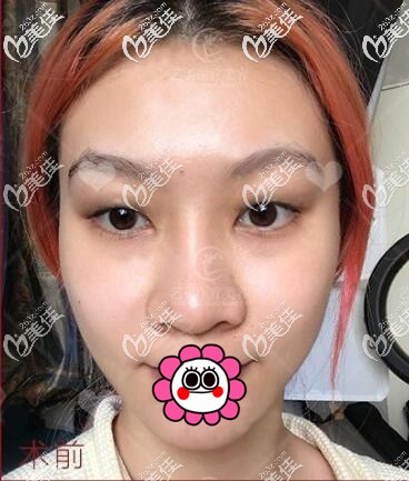 做全切雙眼皮前 做全切雙眼皮前