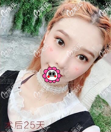 雙眼皮術(shù)后25天效果 雙眼皮術(shù)后25天效果