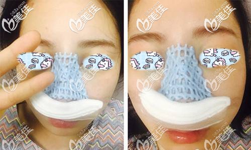 做完自體軟骨隆鼻手術(shù)后即刻