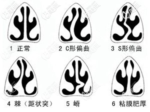 醫(yī)生給出常見的幾種鼻中隔偏曲類型