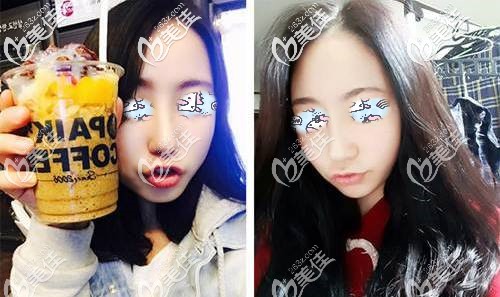 自體軟骨隆鼻術(shù)后30天腫脹漸消