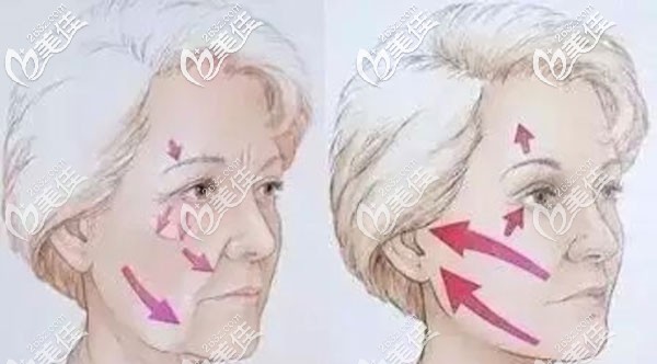 呂佳憶醫(yī)生在埋線提升方面的5大技術(shù)優(yōu)勢(shì) 呂佳憶醫(yī)生在埋線提升方面的5大技術(shù)優(yōu)勢(shì)