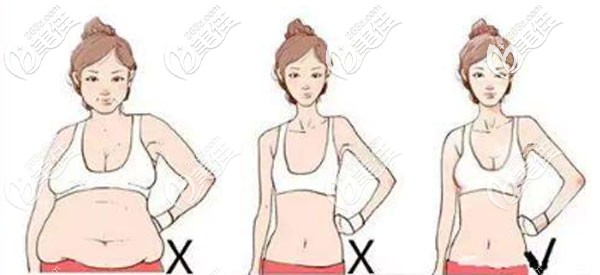 韋潔醫(yī)生埋線減肥的術(shù)后效果圖 韋潔醫(yī)生埋線減肥的術(shù)后效果圖