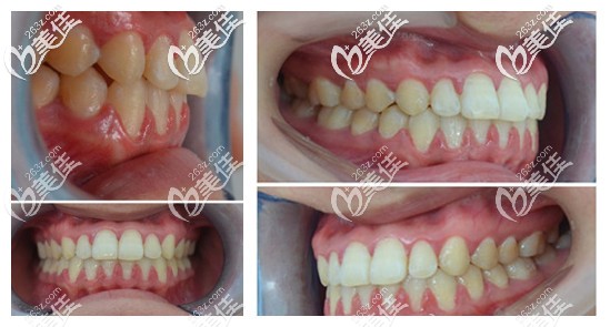 地包天矯正后會更丑？那是你沒看過她30歲帶ormco自鎖托槽牙套矯正后的效果