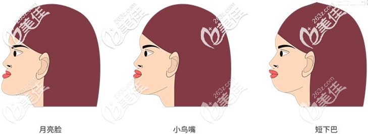 地包天又稱為月亮臉 地包天又稱為月亮臉