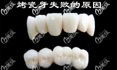 濰坊鄭氏口腔劉寶森講解烤瓷牙修復失敗的原因