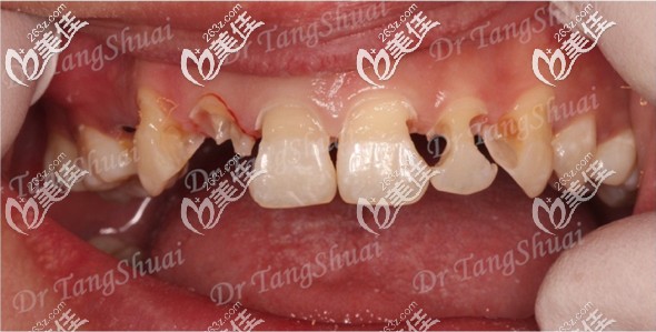 門牙齲齒太難看 門牙齲齒太難看