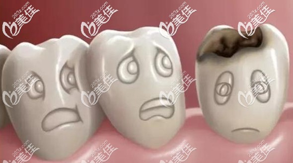 樹脂補(bǔ)門牙的弊端就是時間長了會容易變色 樹脂補(bǔ)門牙的弊端就是時間長了會容易變色