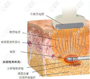 寶麗太吸脂原理示意圖