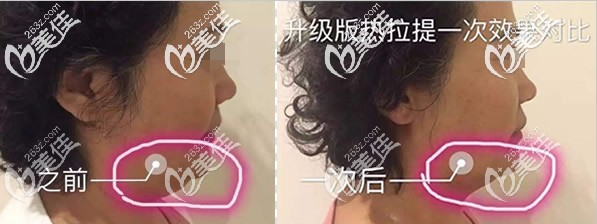 下頜緣做過(guò)一次熱拉提plus的效果