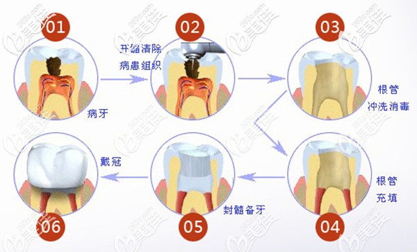 根管治療過(guò)程圖解 根管治療過(guò)程圖解