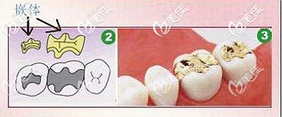 嵌體補(bǔ)牙的優(yōu)勢和原理