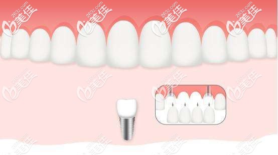 缺4顆牙種兩顆種植牙圖片