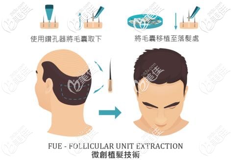 晏醫(yī)生做微創(chuàng)植發(fā)技術(shù)的手術(shù)示意圖