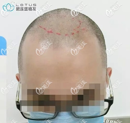 小程頭頂出現(xiàn)一塊斑禿