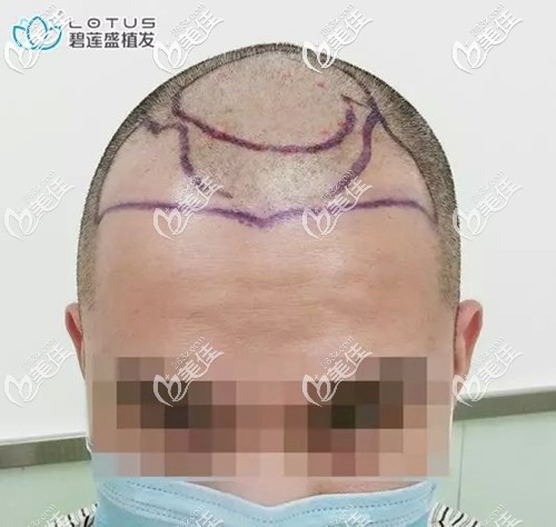 準(zhǔn)備開(kāi)始前額發(fā)際線種植