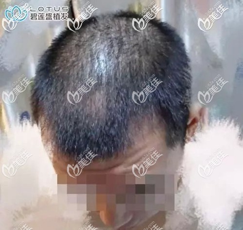 術(shù)后三個(gè)月的種植效果圖