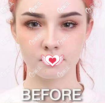 在泰國做假體墊下巴術(shù)前照片 在泰國做假體墊下巴術(shù)前照片