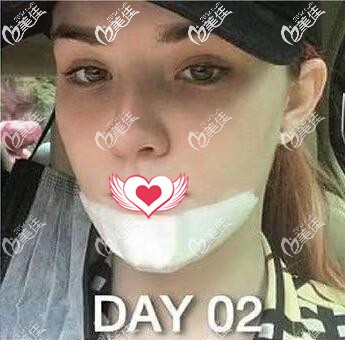 在泰國藝術(shù)整形外科做假體墊下巴術(shù)后第2天 在泰國藝術(shù)整形外科做假體墊下巴術(shù)后第2天