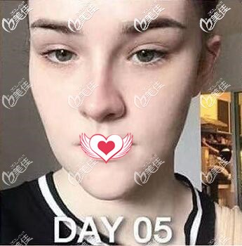 硅膠假體墊下巴術(shù)后第5天恢復(fù)效果 硅膠假體墊下巴術(shù)后第5天恢復(fù)效果