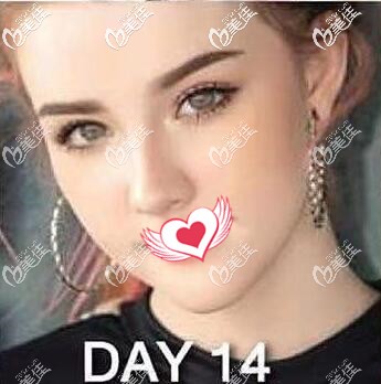 在泰國做假體墊下巴術(shù)后14天恢復(fù)效果圖 在泰國做假體墊下巴術(shù)后14天恢復(fù)效果圖