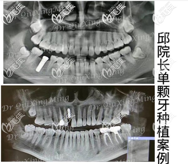 單顆種植牙修復(fù)案例