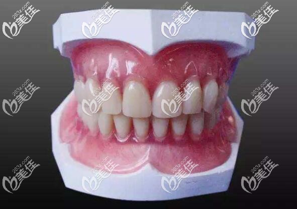 全口固定烤瓷牙