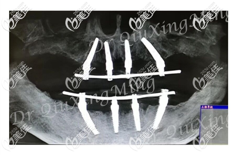 老媽40歲全口無牙在北京私立醫(yī)院做的all on 4滿口種植牙真讓人后悔沒早點去啊