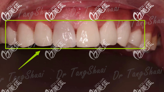 還糾結門牙齲齒能做瓷貼面嗎?我在北京朝陽區(qū)做的超薄全瓷牙齒貼面圖片給你看看