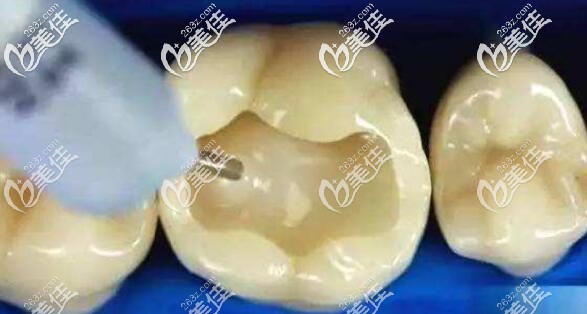 樹脂補牙 樹脂補牙