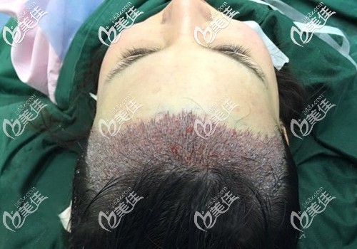 剛種植出來(lái)的美人尖并不是很美麗