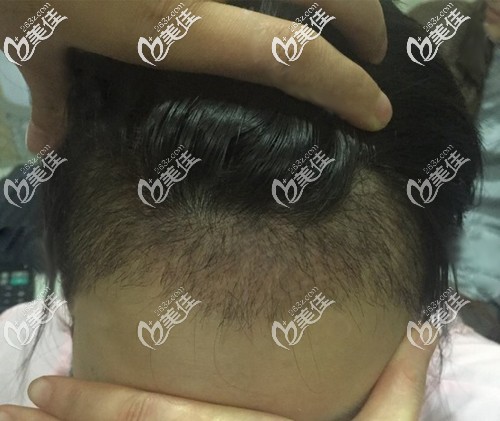 頭發(fā)都長(zhǎng)到1厘米了，竟然進(jìn)入置換期開(kāi)始掉了