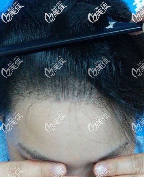 ?以前我特頭疼女生發(fā)際線過高適合什么發(fā)型,花2萬塊植了美人尖發(fā)際線以后發(fā)型隨便變