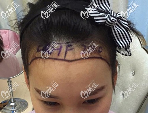 醫(yī)生設(shè)計(jì)的發(fā)際線(xiàn)種植方案