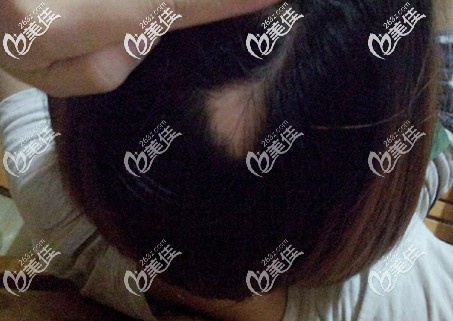 頭頂出現(xiàn)了一塊斑禿咋辦 頭頂出現(xiàn)了一塊斑禿咋辦