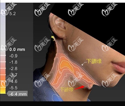 頸部吸脂的位置