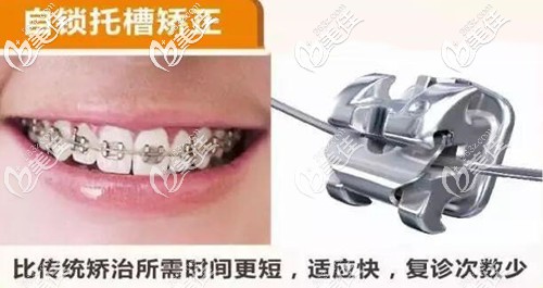 戴金屬自鎖托槽矯正凸嘴