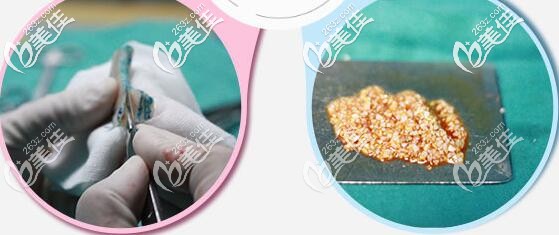 自體軟骨鼻基底填充