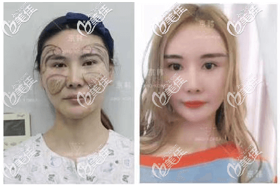 北京喬愛軍面部脂肪填充失敗修復(fù)案例 北京喬愛軍面部脂肪填充失敗修復(fù)案例
