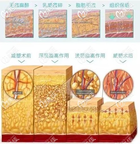 Manatchaya Jedsadakraisorn醫(yī)生做威塑吸脂手術(shù) Manatchaya Jedsadakraisorn醫(yī)生做威塑吸脂手術(shù)